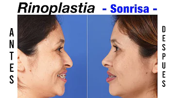 ¿Por qué mi nariz tiene un aspecto extraño después de una rinoplastia?