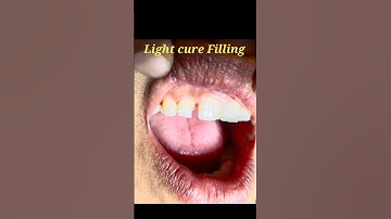 Light cure Composite Filling By Haider...#compositefilling ...#dentalartbyhaider