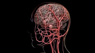 ¿Cómo detectar a tiempo un aneurisma cerebral?