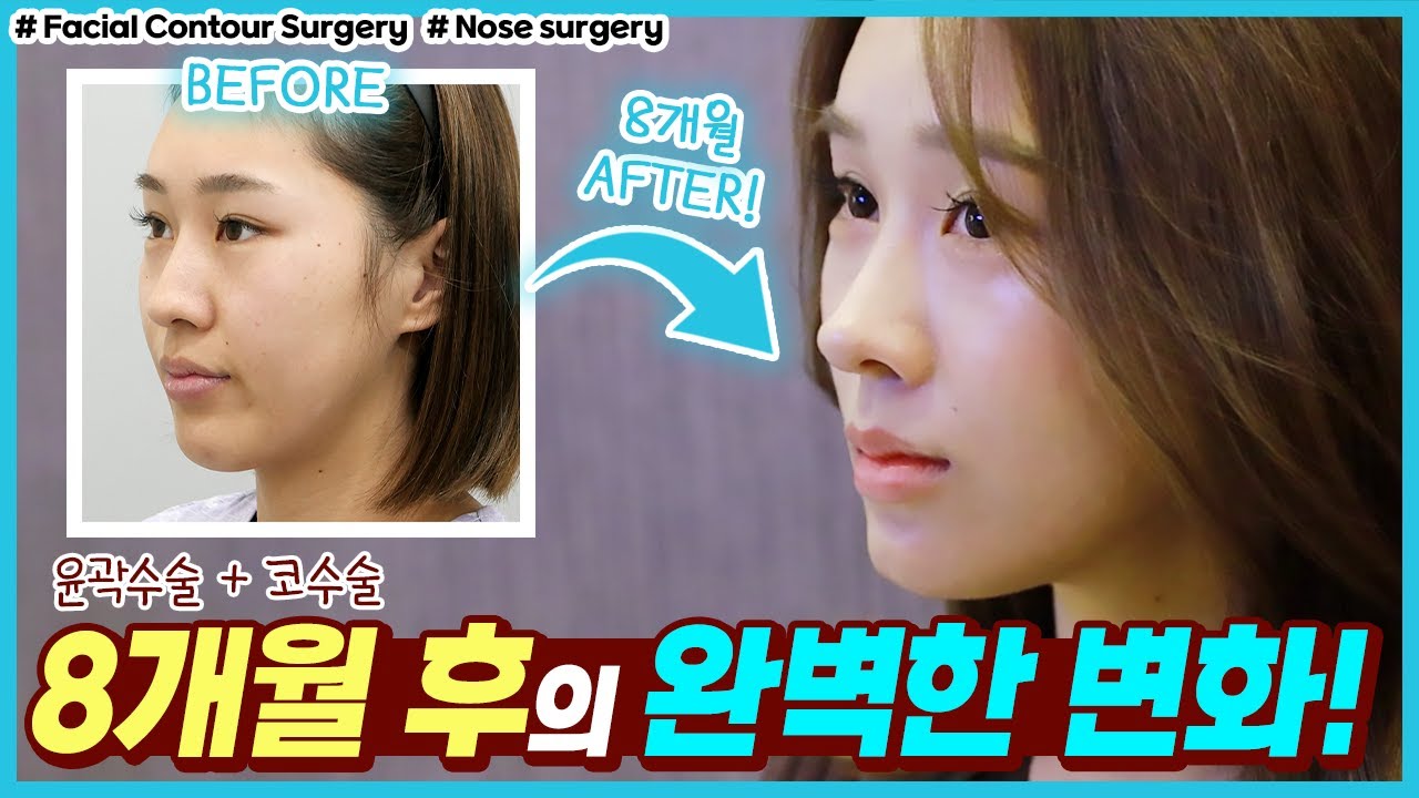 [제이준 성형외과 피부과] Tự nhiên trở nên xinh đẹp nên tôi rất hài lòng~!! Và tôi cũng đã được chăm sóc da nữa!!