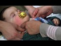 How to Care for Your Child's Skin and Do a Trach Tie Change | Cincinnati Children's