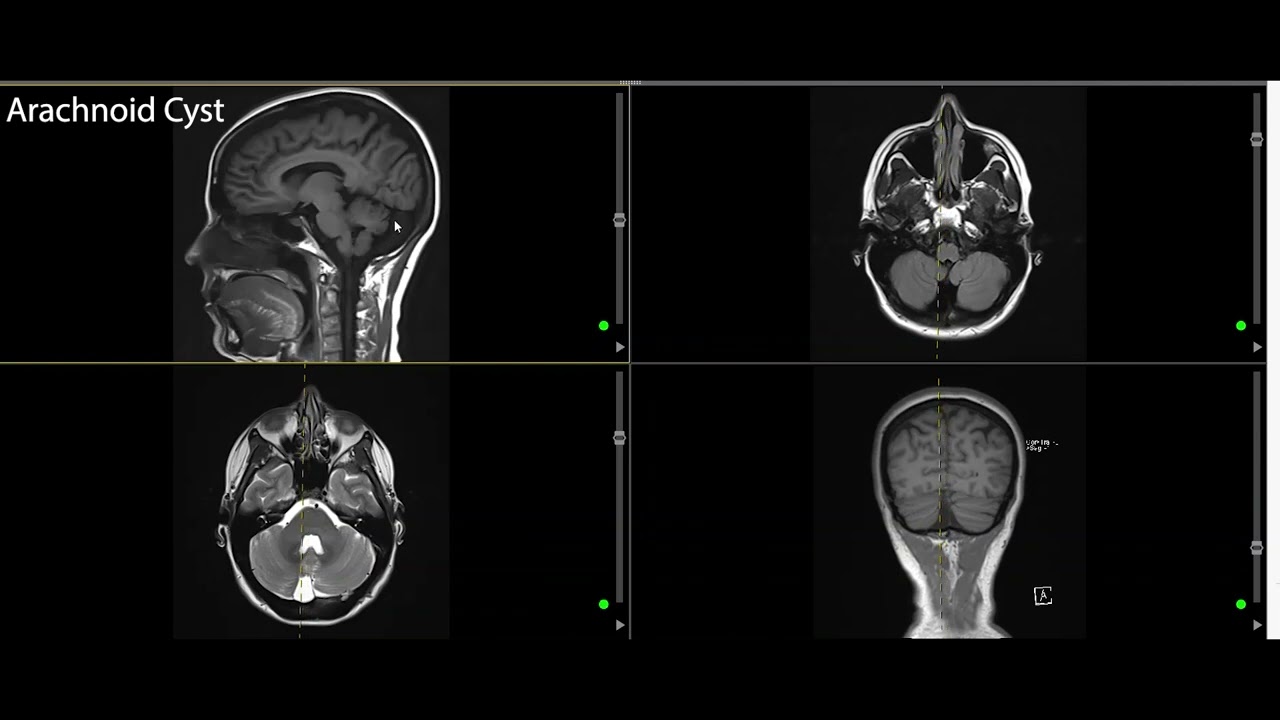 Cysts in the Brain--Arachnoid Cyst