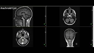 Cysts in the Brain--Arachnoid Cyst