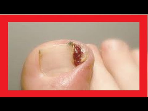 Video: 5 moduri de a ameliora durerea de la unghiile de la picioare încarnate