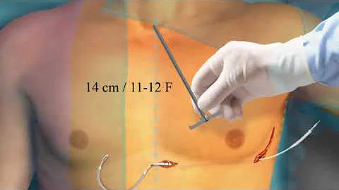 Como é implantado o CDI?