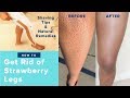 How to Get Rid of Strawberry Legs Fast LIKE A BOSS! | Easy Regimen & AT HOME REMEDIES