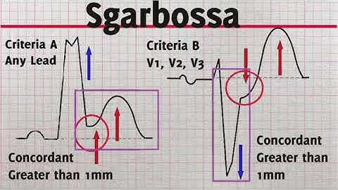 Current ECG Ep 4   Sgarbossa Criteria   STEMI LBBB
