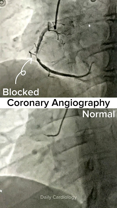Coronary Angiography (Normal vs Blocked)