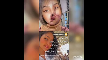نقذو مريم اكو شخص ذب عليه تيزاب وهية نايمة وحترك كل وجهة الله يشفيها يارب 
