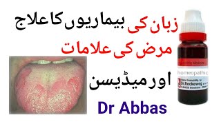 Zaban par chale ka ilaj  | Muh ka Pak Jana |zuban pe zakham| zuban khushk Homeopathic   Khadim Abbas