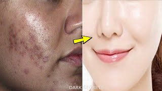 How to Remove DARK SPOTS amp Pigmentation
