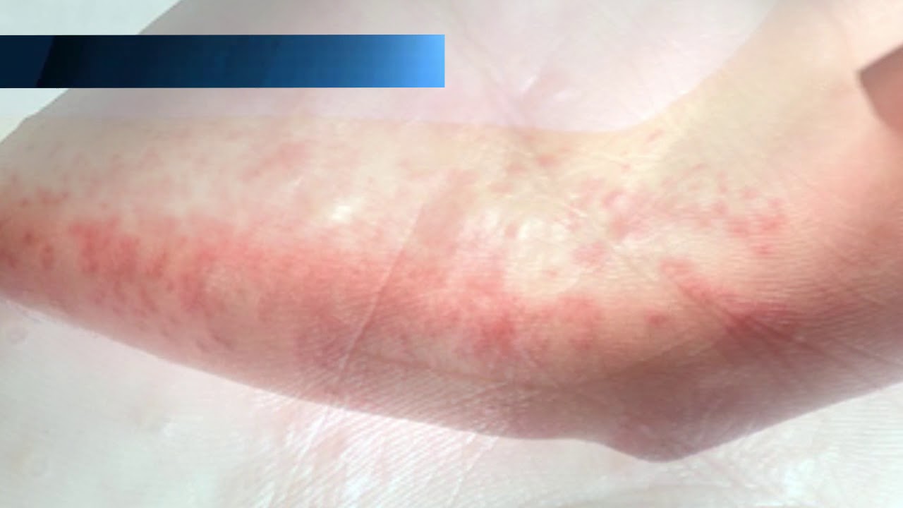 Аллергическая экзема на руках, ногах, у детей и взрослых: как лечить ...