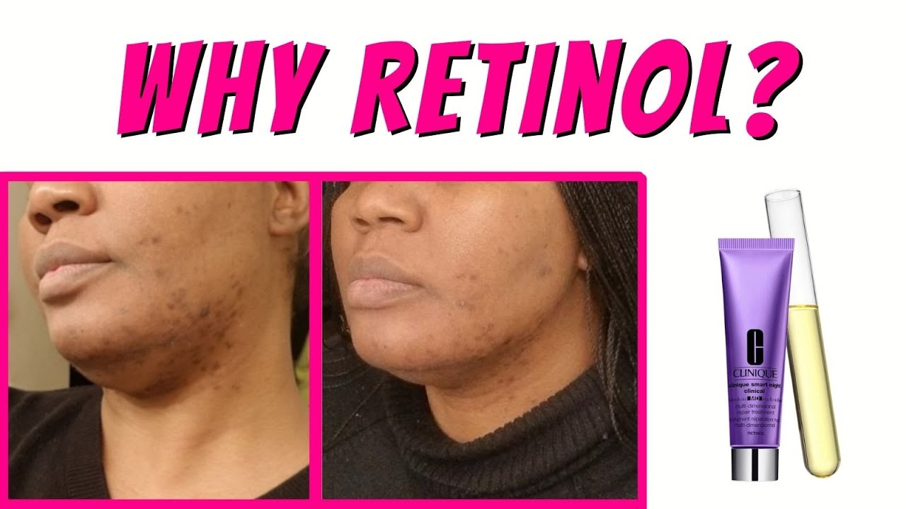 Retinol for acne scars