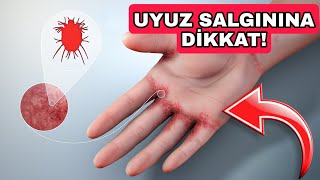 Uyuz Hastalığı Nasıl Geçer? Uyuz Nasıl Bulaşır? Uyuz Belirtileri Ve Uyuz Tedavisi 