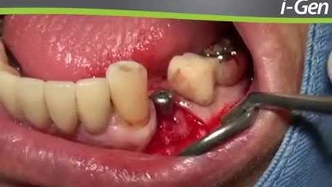 Membrane I-Gen : GBR using a titanium mesh