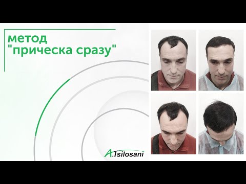 А.Цилосани - ПЕРЕСАДКА ВОЛОС по методу "прическа сразу". Результат через 4 часа и на всю жизнь.