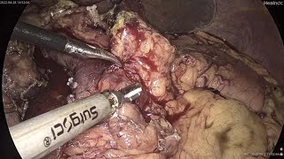 The Use of Surgsci's Ultrasonic Scalpel in Laparoscopic Gallbldder-Preserving Surgery (2)