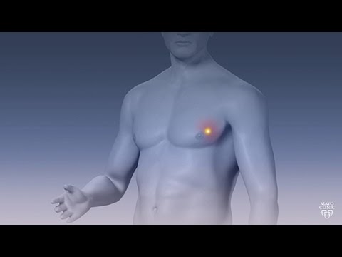 Wideo: 3 sposoby diagnozowania męskiej choroby piersi