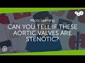 Can you tell if these aortic valves are stenotic?