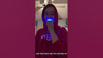 Do Teeth Whitening Kits Really Work? this is the answer