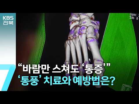 [건강 쏙! 쏙!] “바람만 스쳐도 ‘통증’”…‘통풍’ 치료와 예방법은? / KBS  2026.02.10.