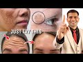 Get Rid Of Wrinkles, fine lines and Dark spots And Get Younger Looking Skin - Dr. Vivek Joshi