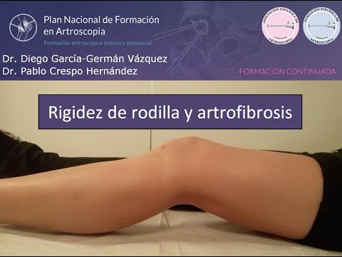 Rigidez de Rodilla y Artrofibrosis. Artrolisis Artroscópica. Artroscopia de Rodilla.