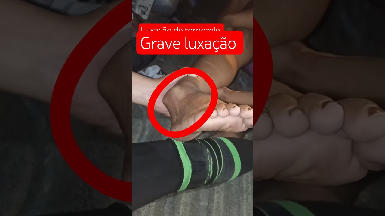 🚨 Tornozelo Saiu do Lugar? Luxação de Tornozelo: Sintomas e Primeiros Socorros #viralbrasil #shorts