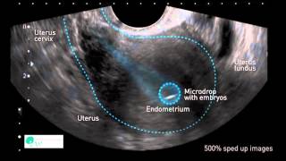 Masturbation After Embryo Transfer
