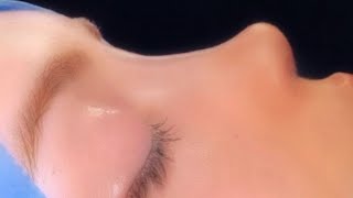 Virtual Rhinoplasty- Small Nose Subliminal