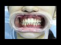 1 teeth straightening in chennai  senthil dental care