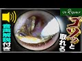 分厚い耳垢一気にゴソッと！！　ear wax removal
