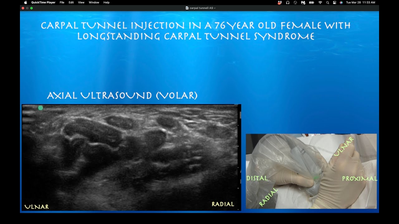 Ultrasound Guided Carpal Tunnel Injection By Probeultrasound YouTube Ultrasound Guided Carpal Tunnel Injection By Probeultrasound YouTube