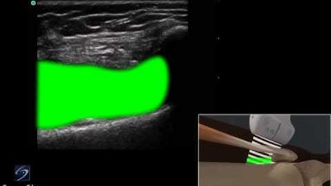 How to: Ultrasound Guided Injection of the Medial Knee 3D Video