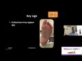 OrthoTV Original   Lisfranc Fracture Dislocation   Dr Pradeep Moonot