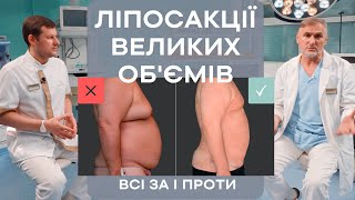 ЛІПОСАКЦІЯ ВЕЛИКИХ ОБ’ЄМІВ 😱 РИЗИКИ, ОСОБЛИВОСТІ