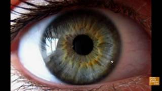 IRIDOLOGY LESSON: SKIN RINGS ARE NOT HEALTHY