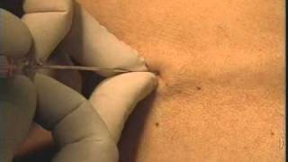 Эпидуральный катетер - epidural katheter(Постановка эпидурального катетера., 2011-11-10T21:59:58.000Z)