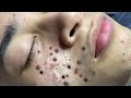 Relax skincare everyday with acne blackheads treatment spa 98044