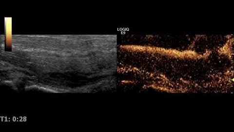 Tissue flap perfusion imaging