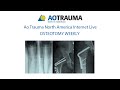 Osteotomy week 10 june 20 diaphyseal and distal tibia ask the experts