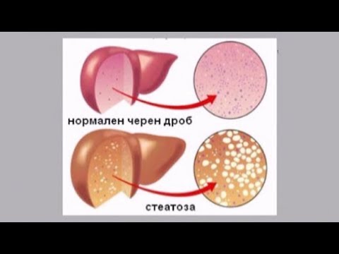 Видео: Симптоми на черния дроб - пясъчен паразит и методи на лечение