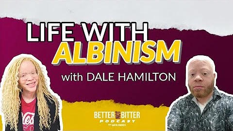 What is Living with Albinism Like w/ Dale Hamilton