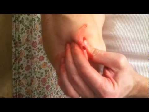 How To Remove A Tumor On A Dog At Home How To Remove A Tumor On A Dog At Home
