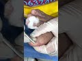 Ep_4217 Foot nails skin removal 👣 ชิ้นนี้..ที่ทำให้เจ็บ 😁 (clip from Thailand)