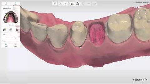 TRIOS® Practice Lab   Bridge workflow