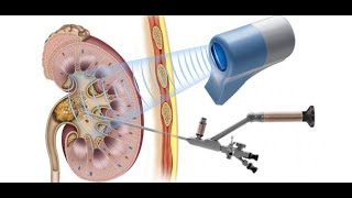 احدث طرق ازالة و تفتيت حصوات الكلى