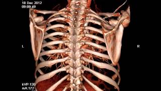 Компьютерная томография грудной клетки-2.wmv(, 2013-01-18T19:42:33.000Z)
