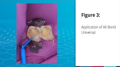 All-Bond Universal Selective Etch Case