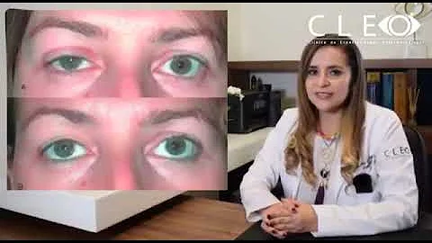 ¿Qué es la ptosis leve?